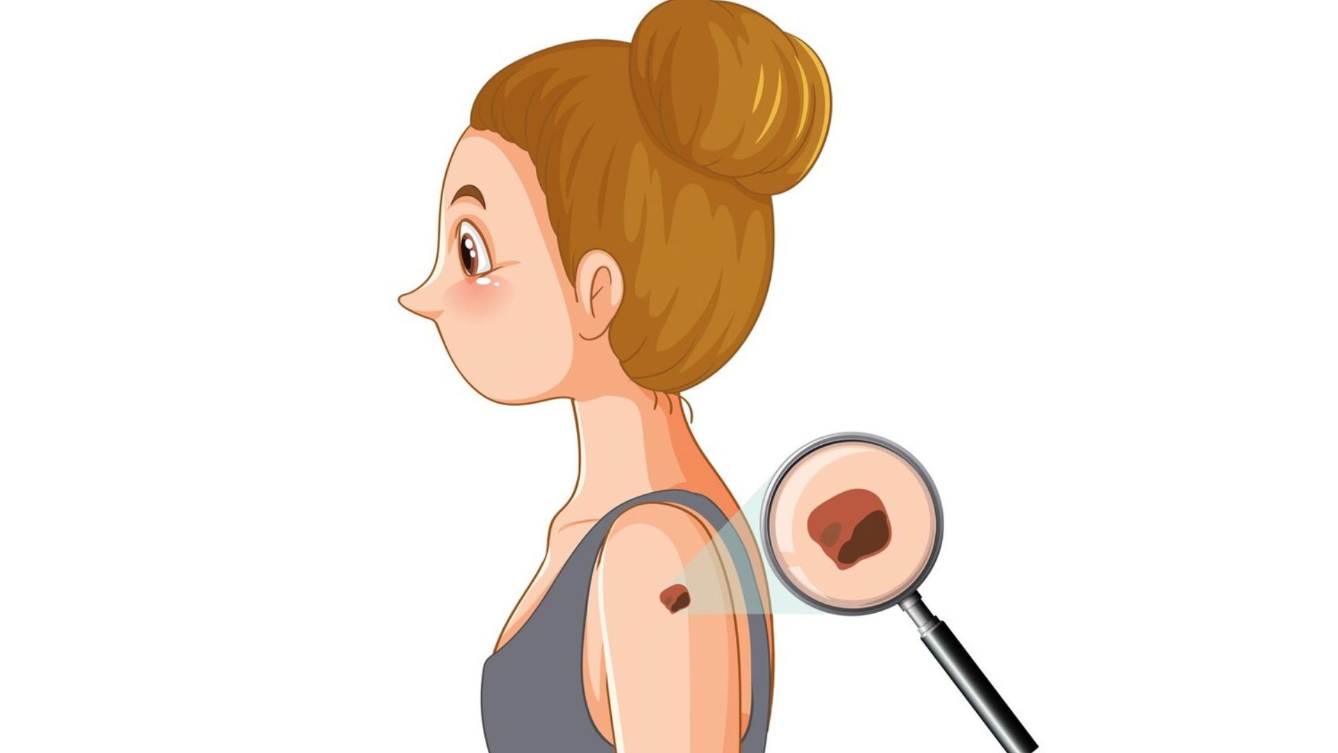 Is It Expensive to Get a Mole Removed in Brisbane?