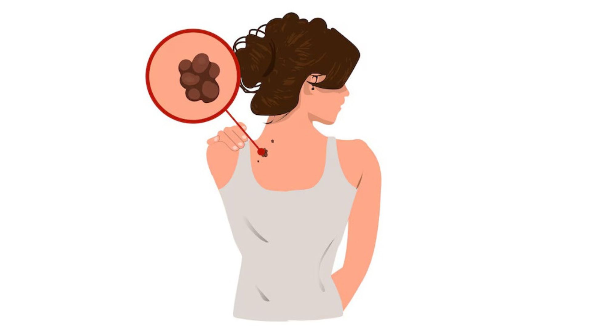 Mole Mapping: Diagnose Melanoma & Skin Cancer Early
