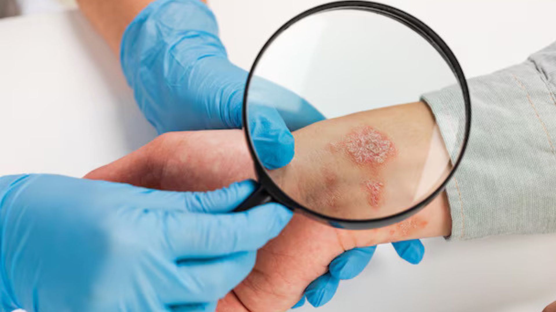 Skin cancer