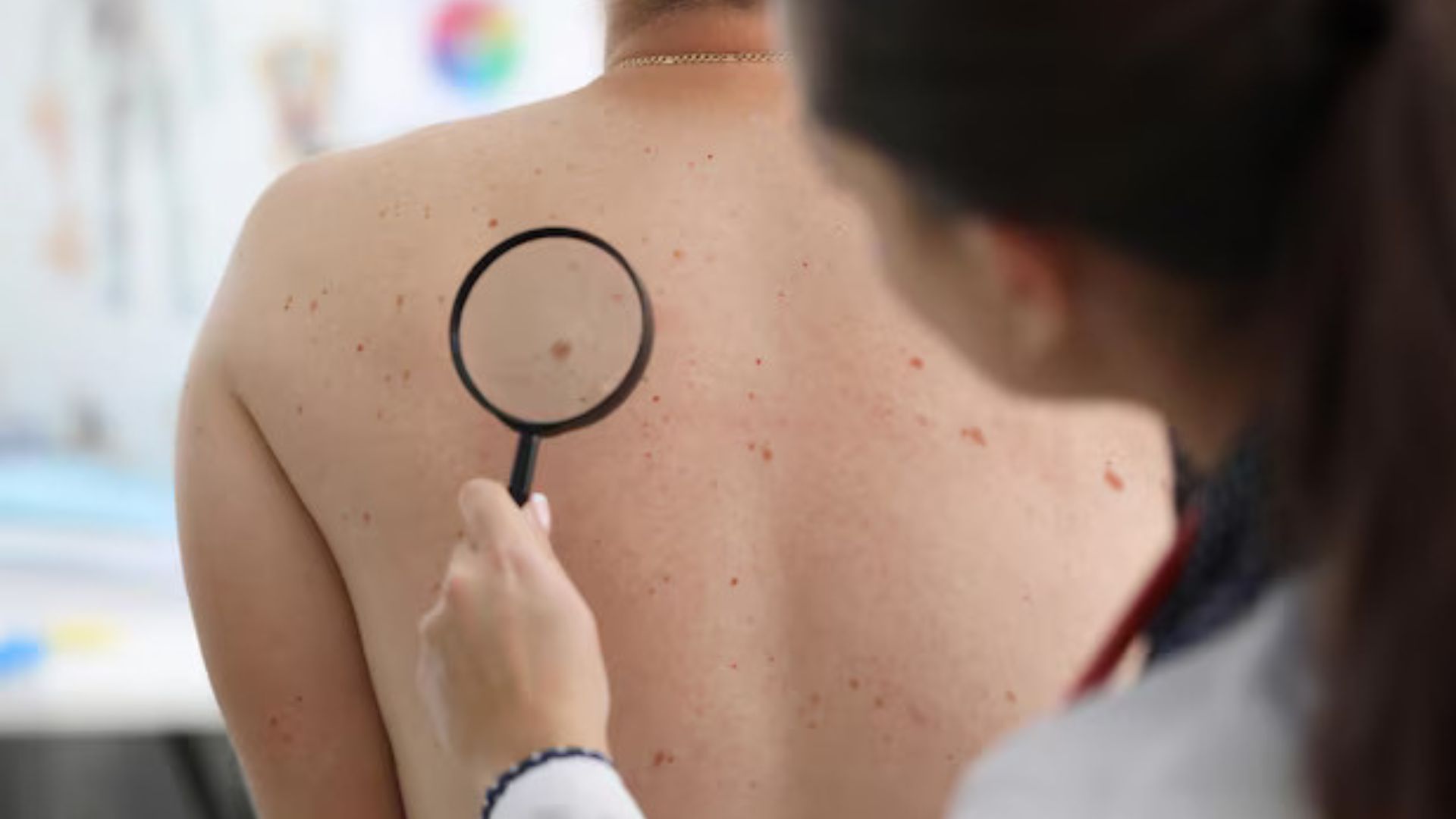 Melanoma and Amelanotic melanoma