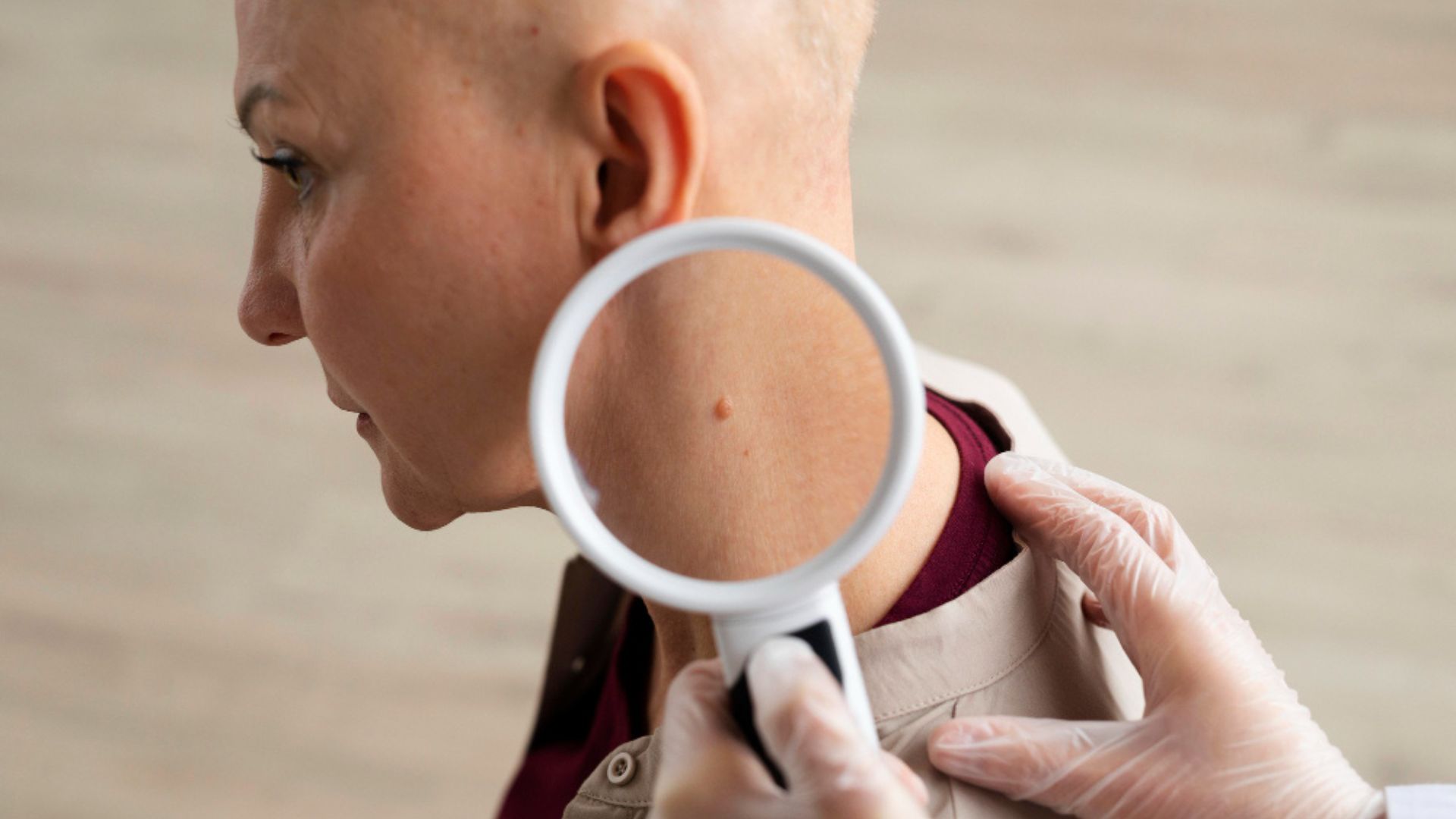 Basal Cell Carcinoma