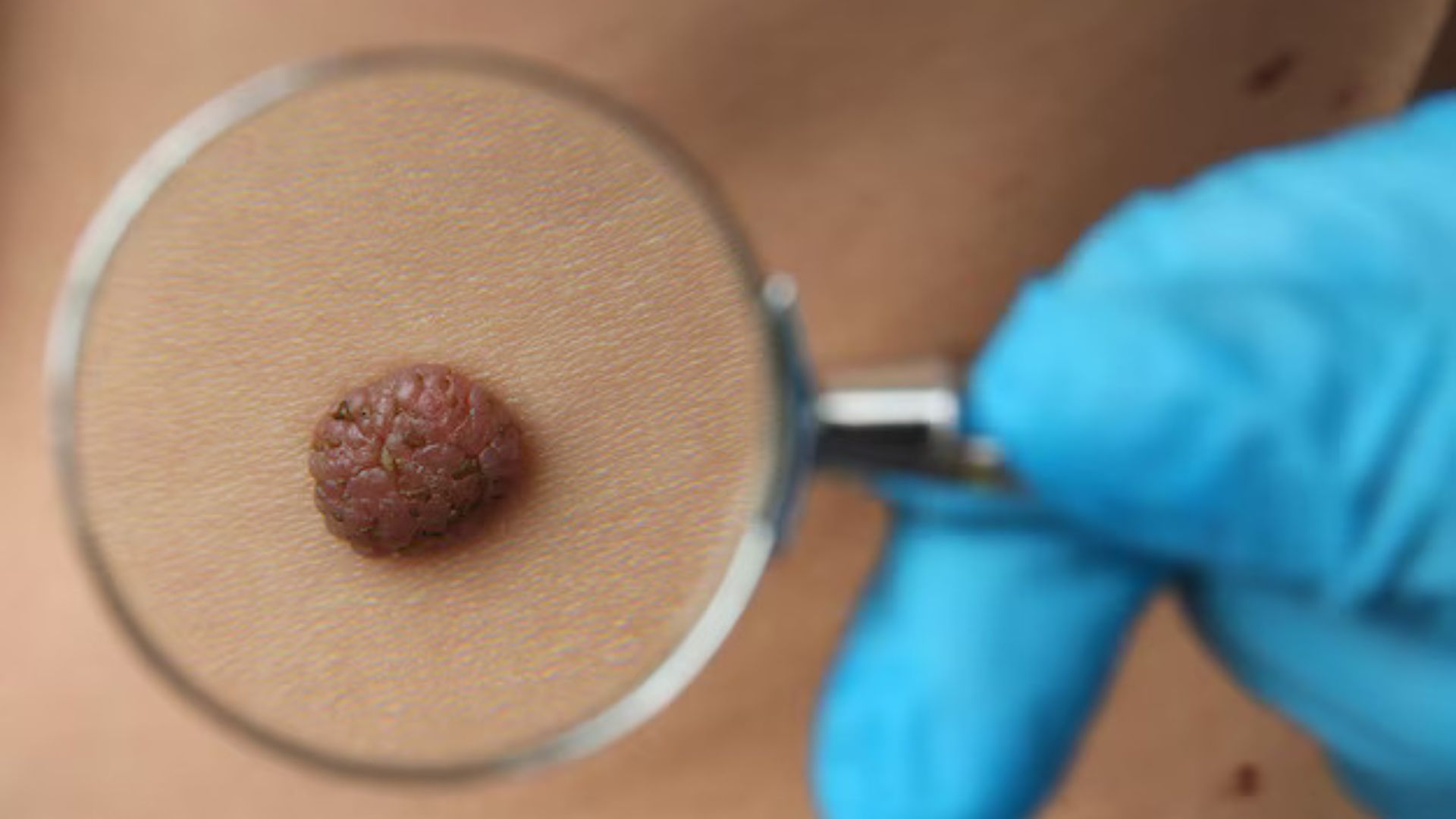 black melanoma
