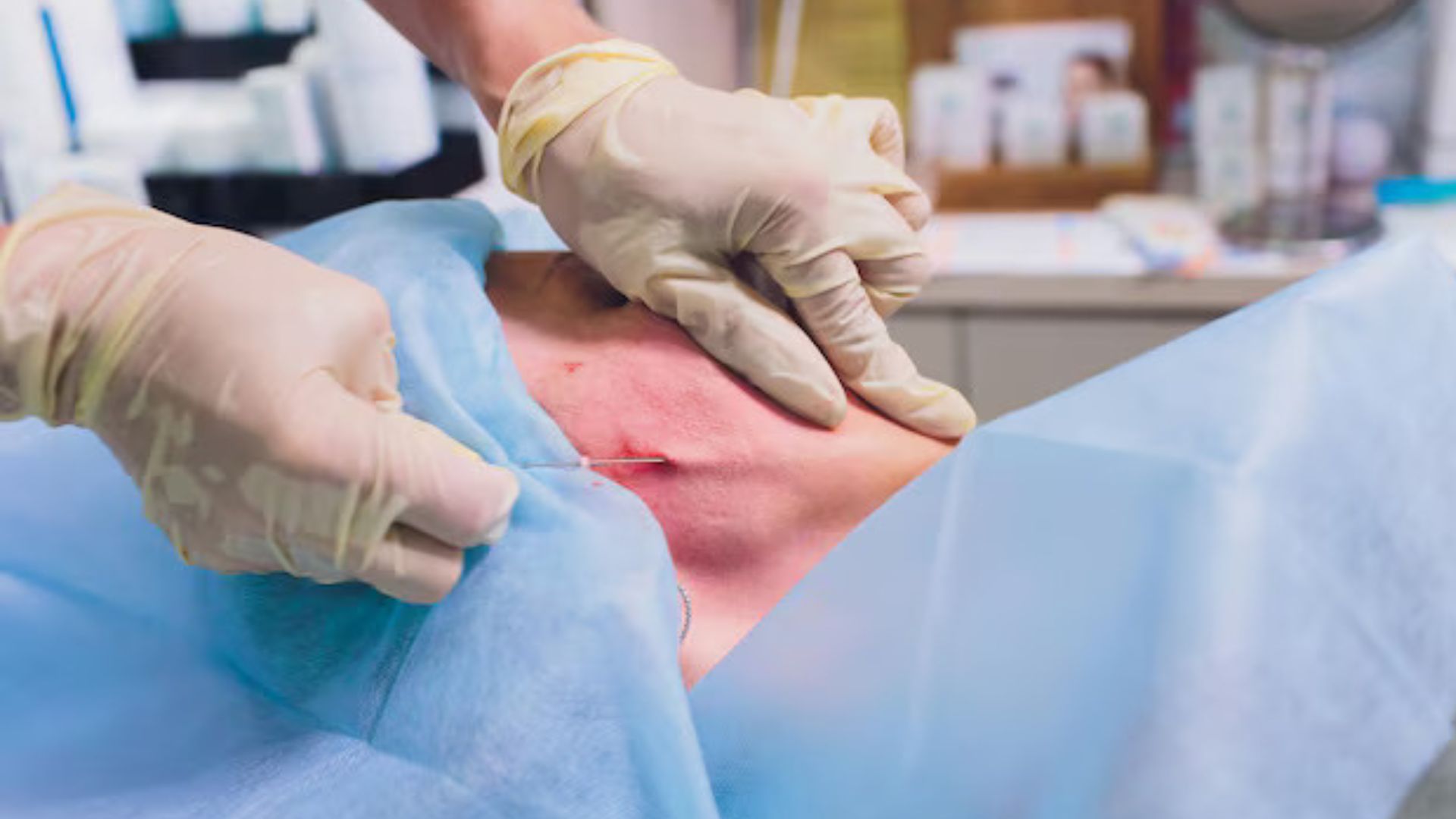 Skin Cancer Removal Surgery