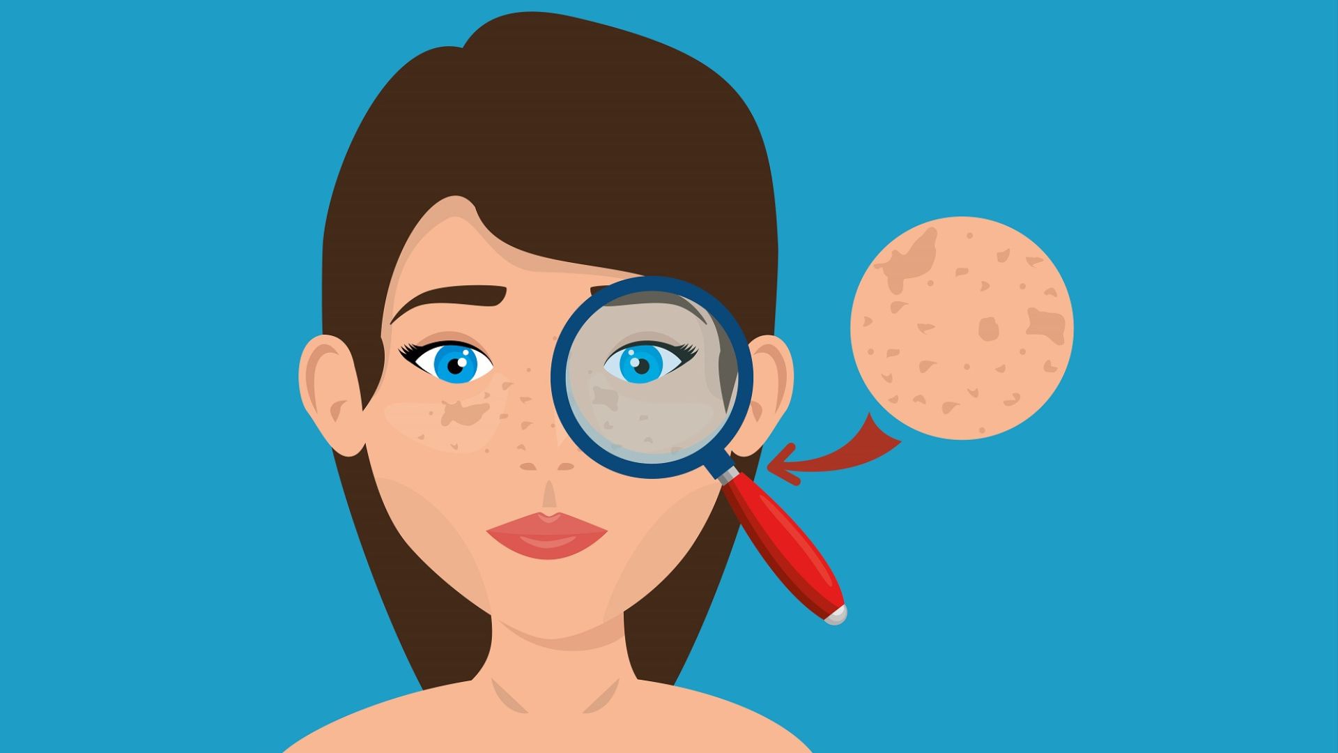 Basal Cell Carcinoma