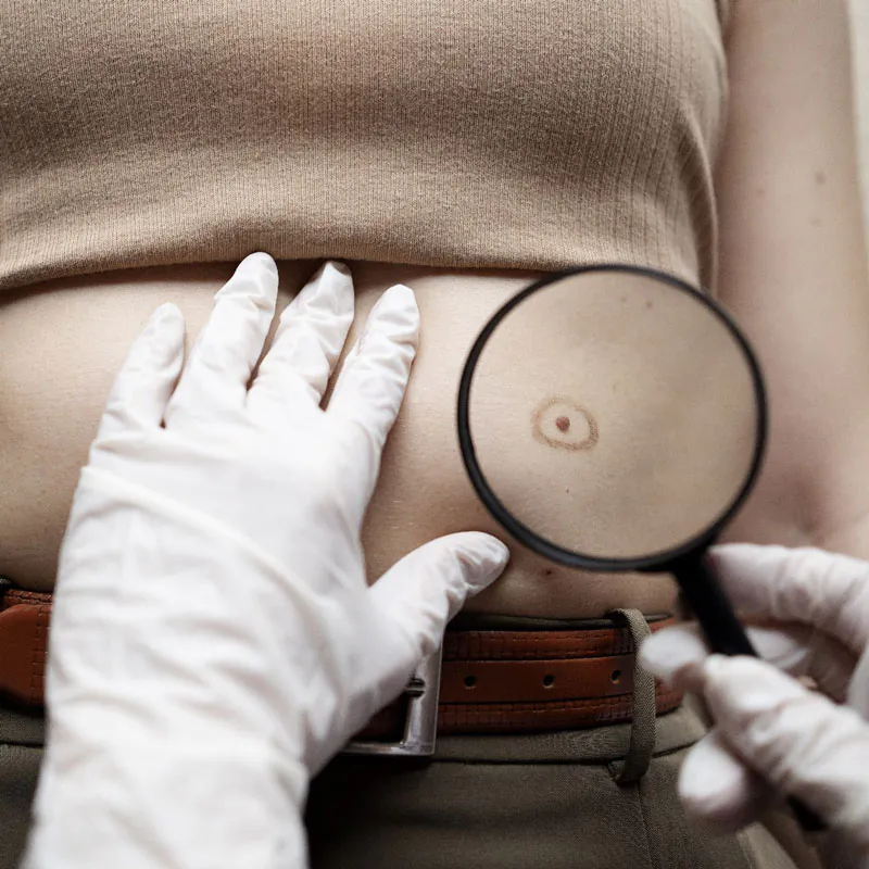 Skin cancer prevention