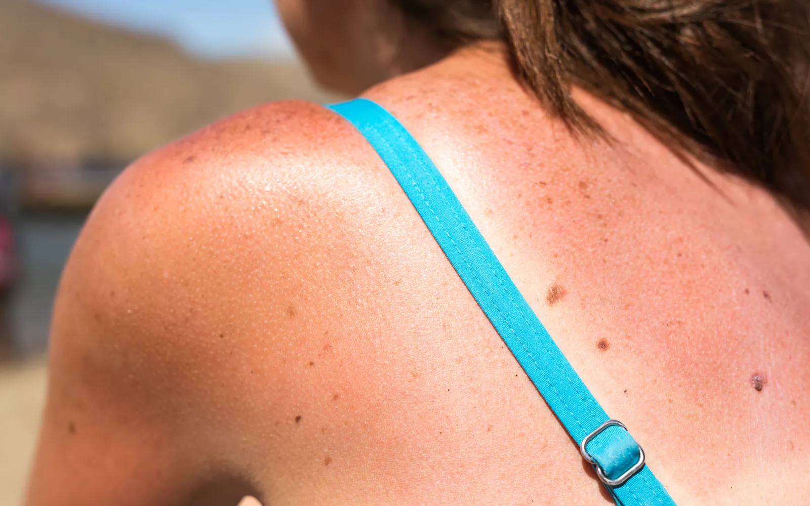 Skin cancer treatment